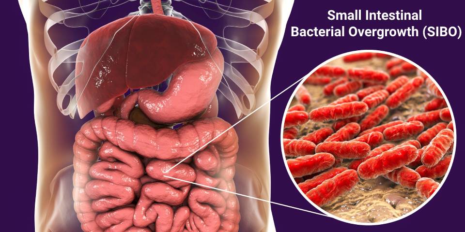small intestinal bacterial overgrowth sibo