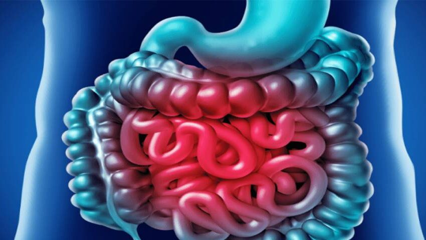 Treatment of SIBO