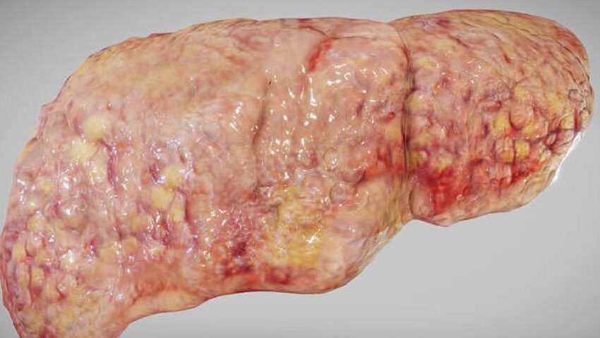 fatty liver