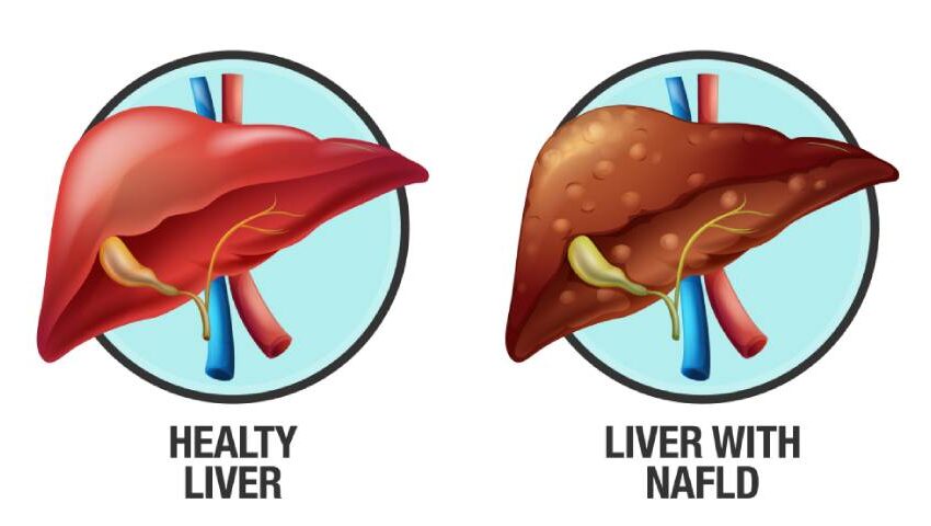 NAFLD Treatment