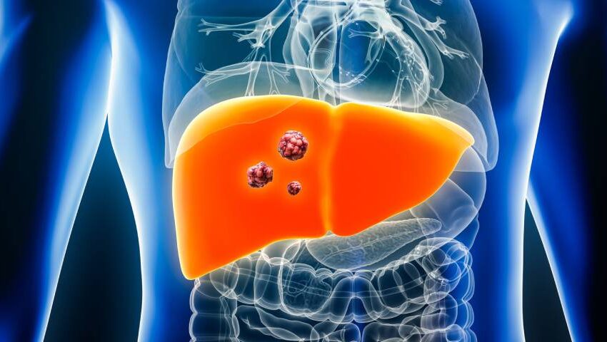 Understanding Liver Cancer: Types, Causes, and Risk Factors