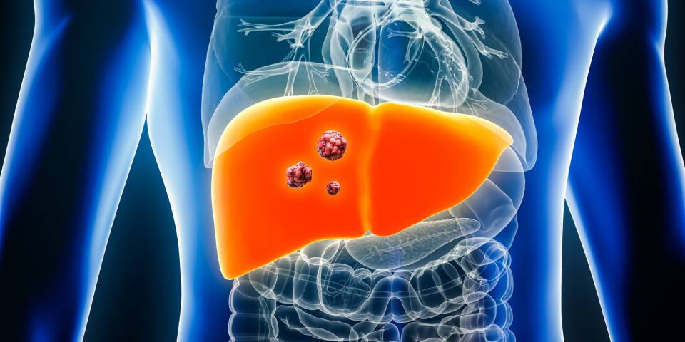 Understanding Liver Cancer: Types, Causes, and Risk Factors